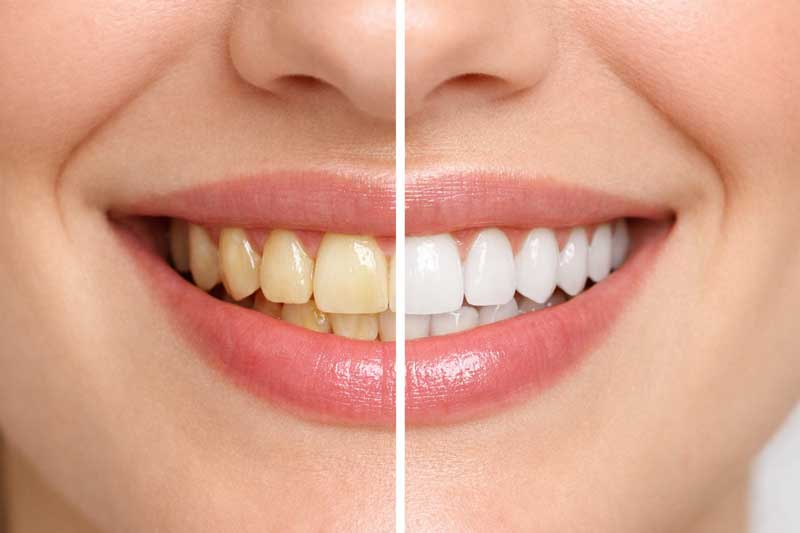مزایای بلیچینگ دندان