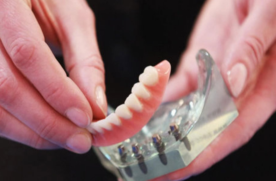 دندان مصنوعی ثابت 