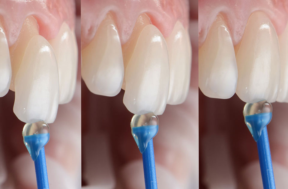 لمینت دندان کرج ارزان