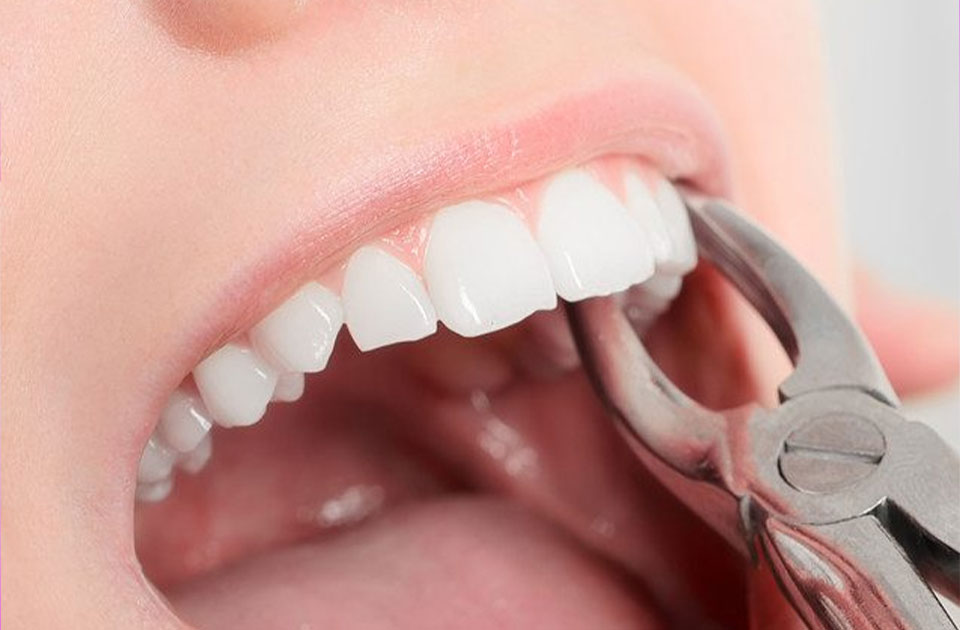 کشیدن دندان همزمان