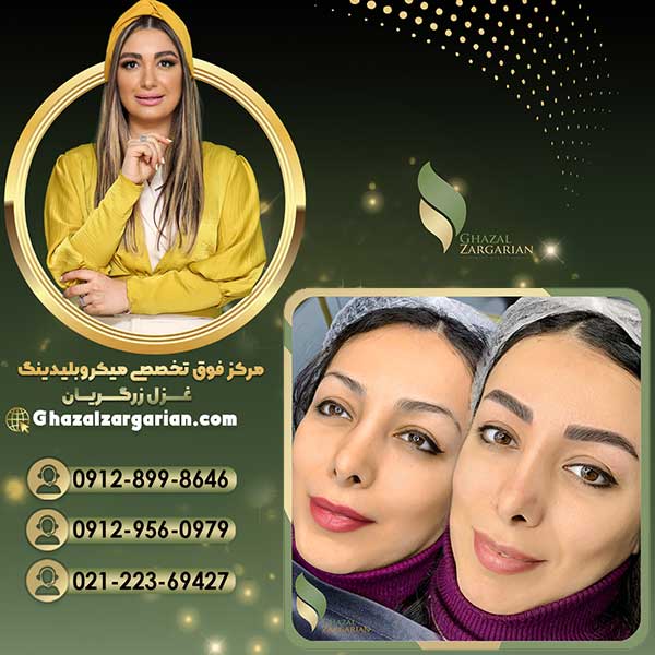 میکروبلیدینگ با التهاب و درد کمتر