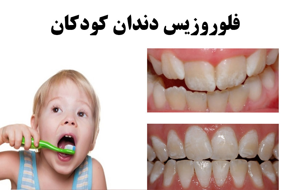 فلوروزیس دندان کودکان 