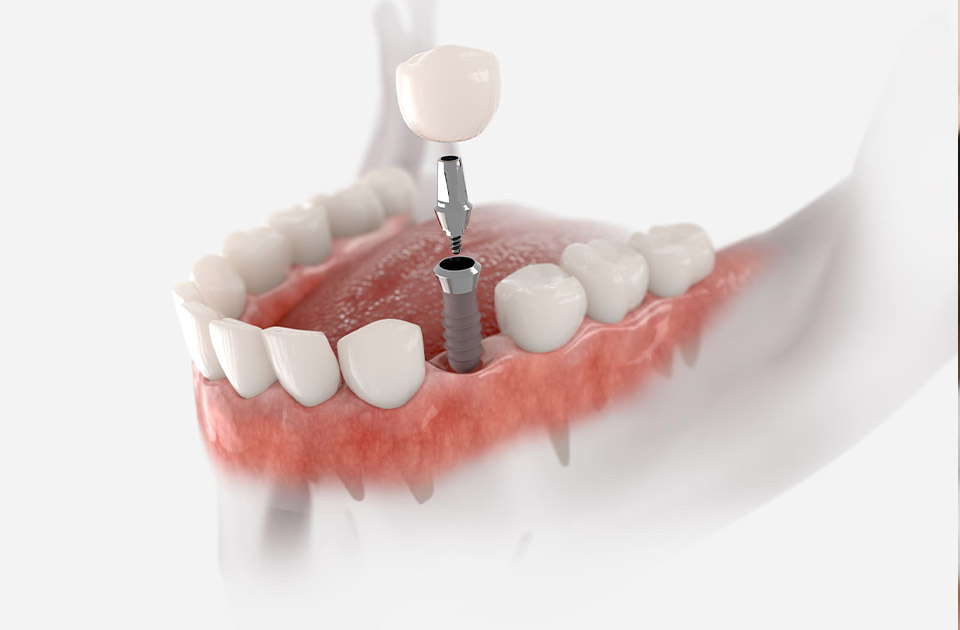 دندان قروچه و ایمپلنت دندان 
