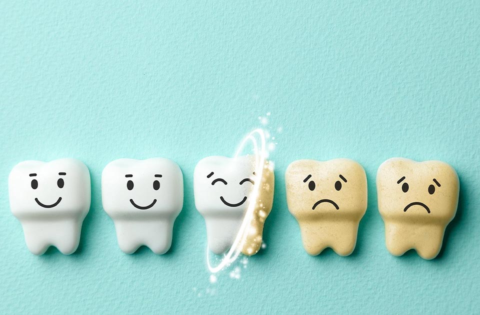 سفید کردن دندان ( بلیچینگ 