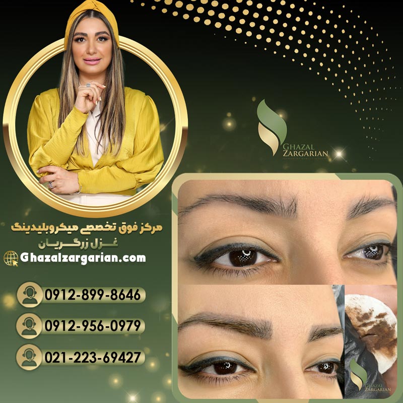 ریموو تاتو ابرو در بهترین مرکز