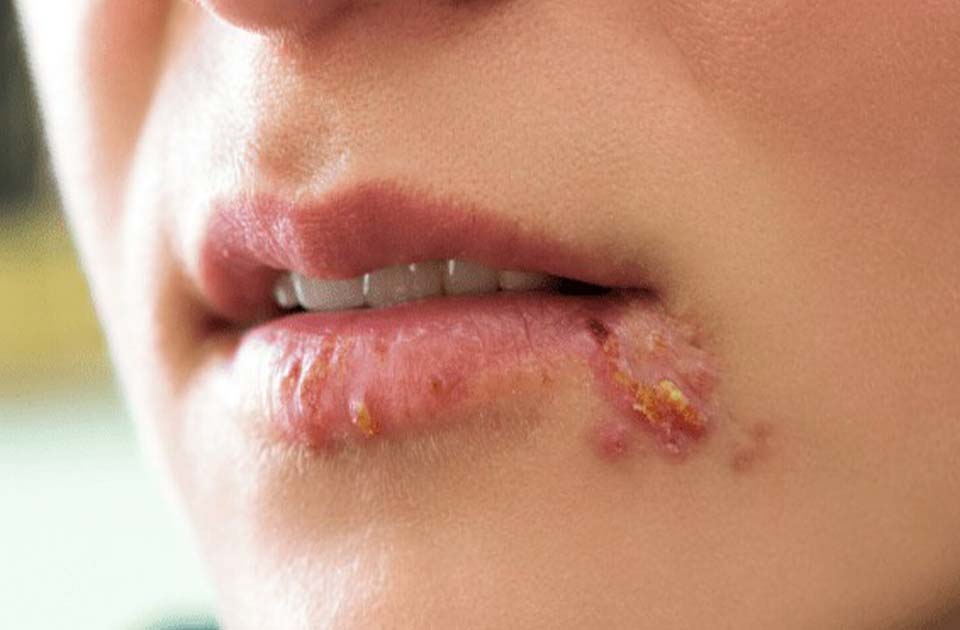 دندان ، دندانپزشکی شبانه روزی ، دندانپزشکی دریا ، کلینیک دندانپزشکی در کرج ، زخم گوشه لب