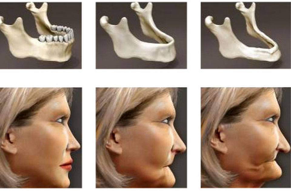 روش تشخیص تحلیل رفتن استخوان فک 