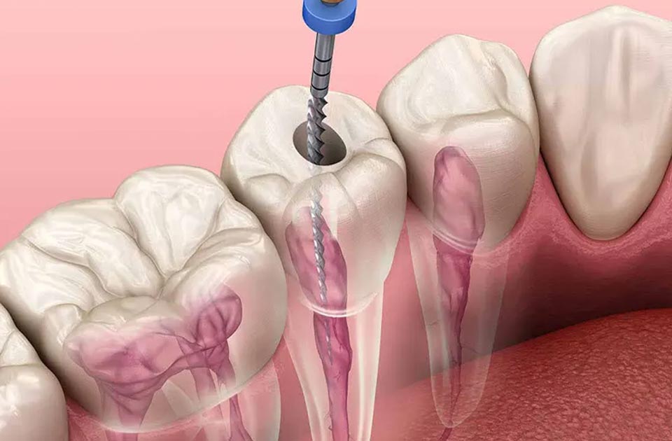 مراحل جراحجی پری آپیکال دندان 
