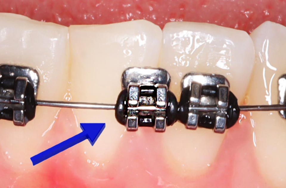 شل شدن براکت ارتودنسی دندان 