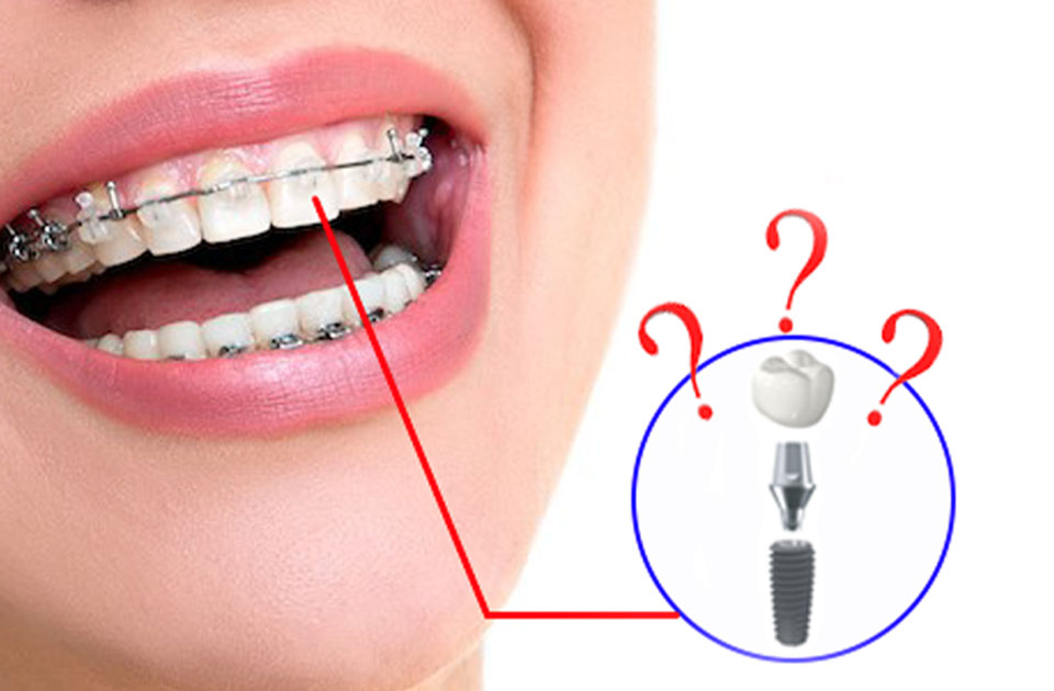 ارتودنسی دندان ایمپلنت شده 
