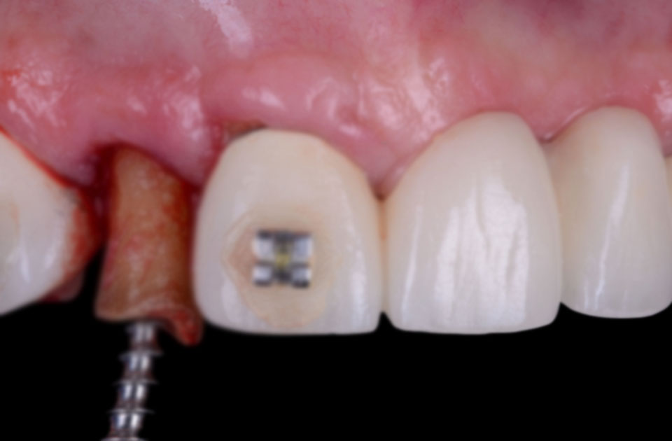 مراحل ایمپلنت دندان به روش پانچ