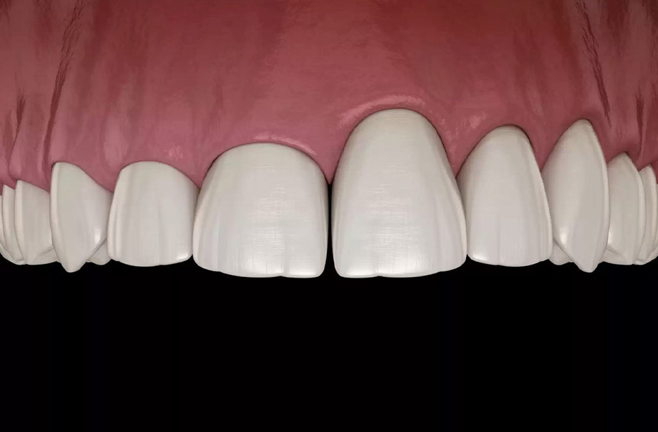 دلایل کوتاه بودن دندان ها و ساختار آن ها 