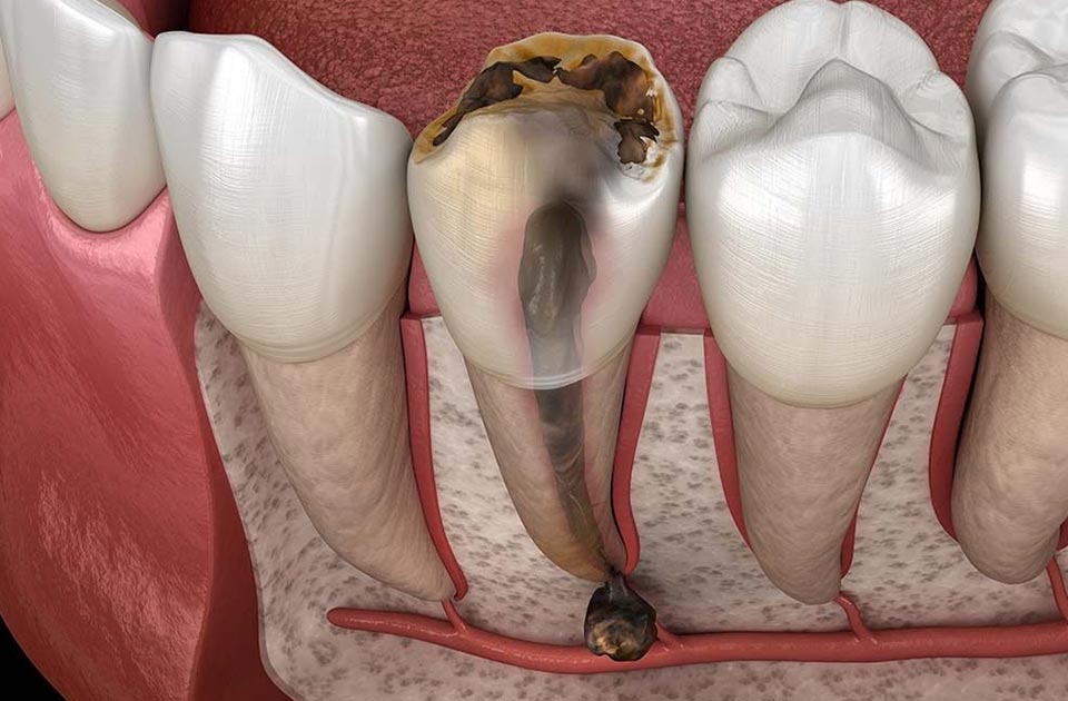 عوارض ها جراحی پری آپیکال دندان 