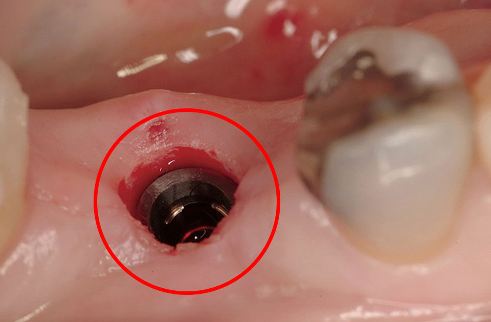 ایمپلنت دندان به روش پانچ 