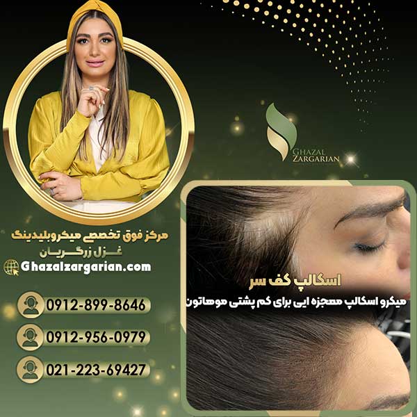 هاشور اسکالپ سر با متریال اورگانیک