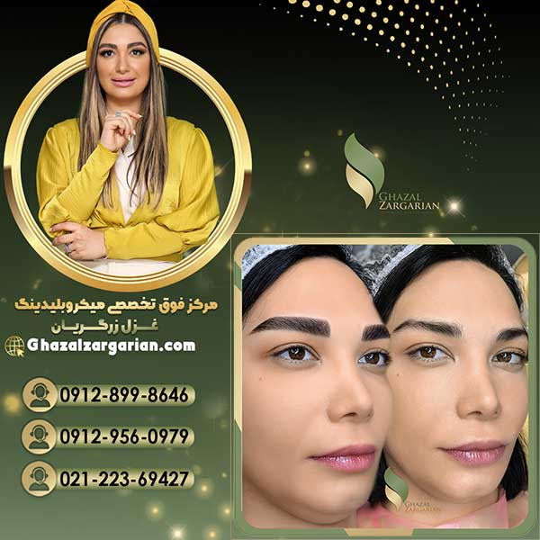 فیبروز ابرو با کیفیت تضمینی