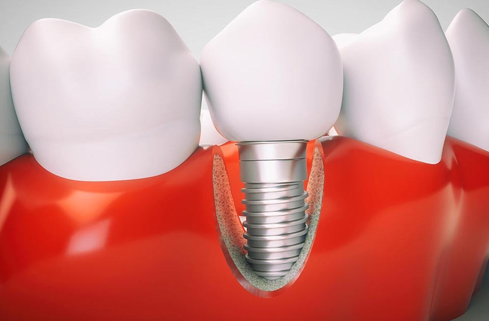 ایمپلنت دندان ، بارداری ، دندانپزشکی شبانه روزی ، کلینیک دندانپزشکی در کرج