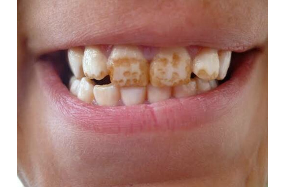 فلوروزیس دندان کودکان و درمان آن 