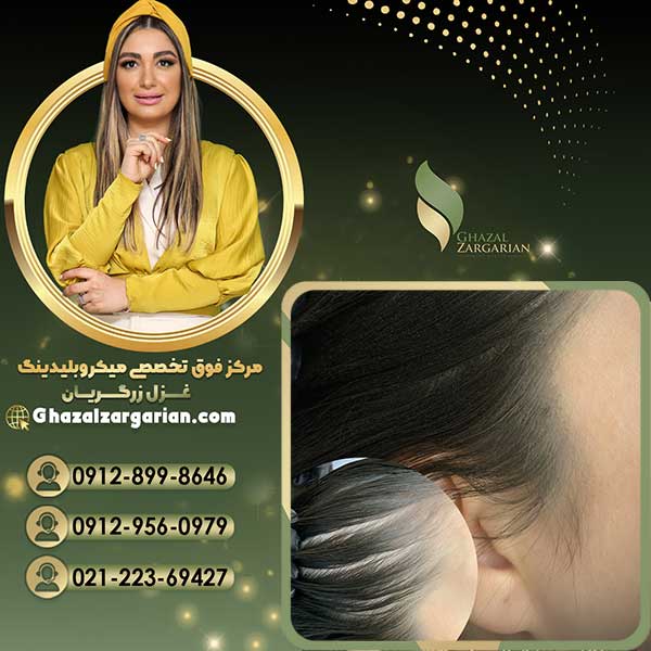 هاشور اسکالپ سر بدون درد