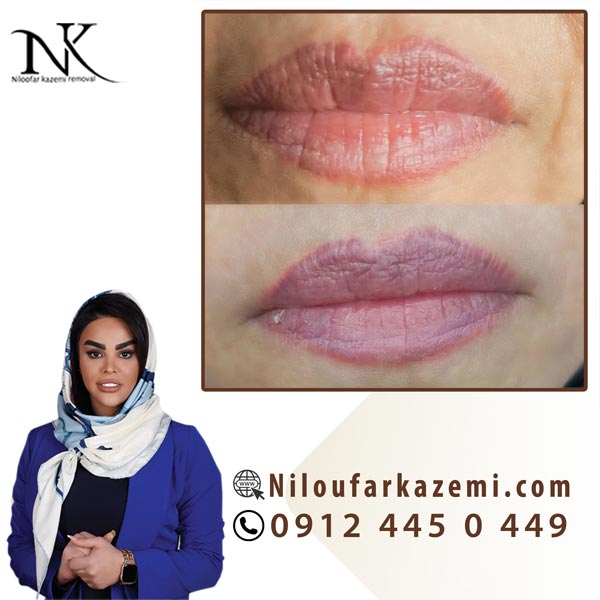 ریموو تاتو خط لب با روش استفاده از مواد ریموور در یک جلسه