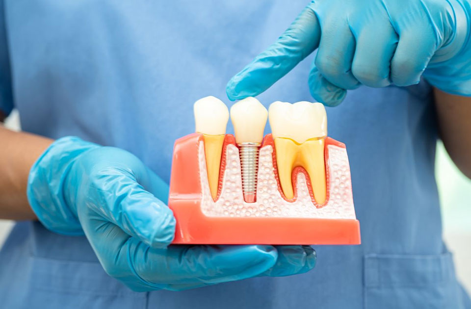 نکات مهم ایمپلنت دندان