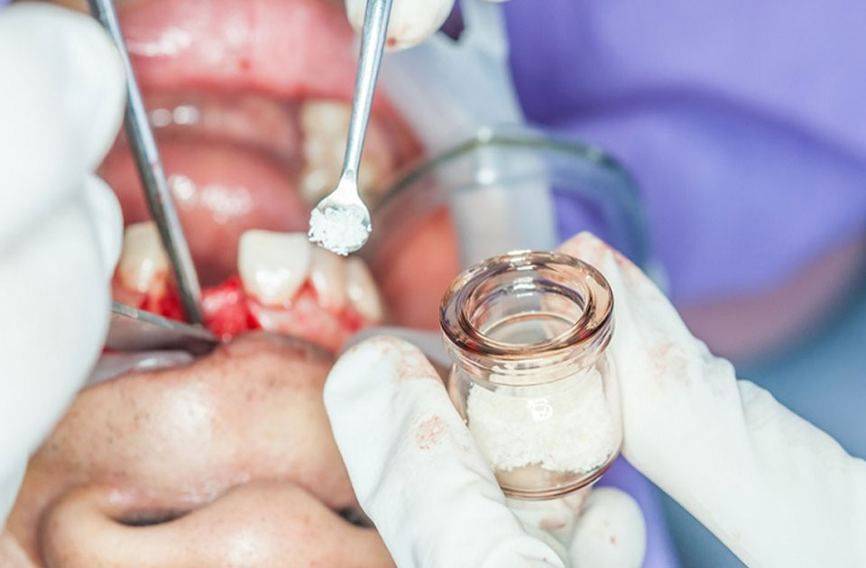 پیوند استخوان فک و دندان