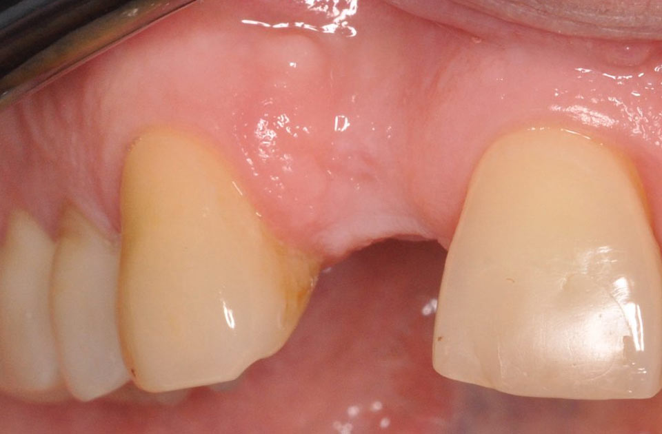 دلایل کشیدن دندان