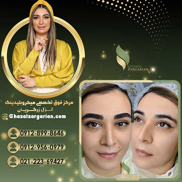 آموزش فیبروز نسبت به فرم چهره