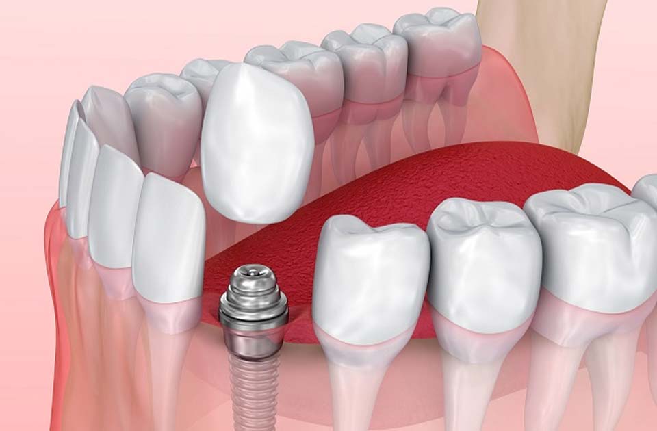 ایمپلنت سوئیسی 