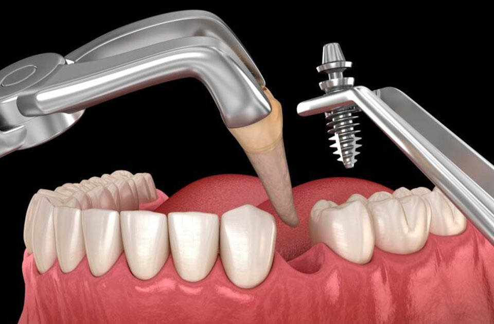 درمان پس زدن ایمپلنت دندان 