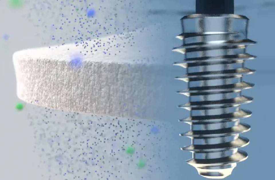 ویژگی منحصر به فرد ایمپلنت مگاژن