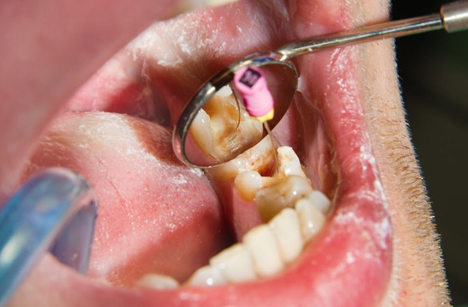 دندانپزشکی شبانه روزی ، کلینیک دندانپزشکی در کرج ، دندانپزشکی ، کرج ، شبانه روزی ، عصب کشی دندان 