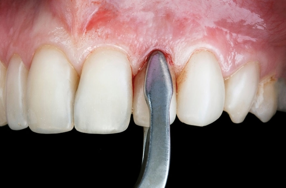 مراقبت های بعد از کشیدن دندان