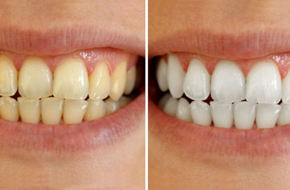 روش های سفید کردن دندان