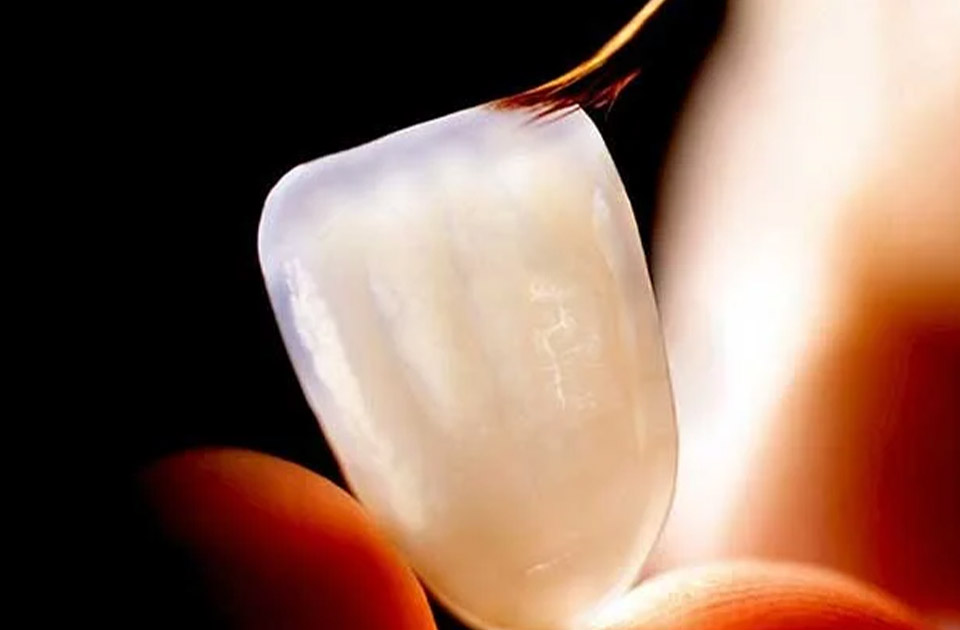 عدم چسبندگی لمینت دندان 