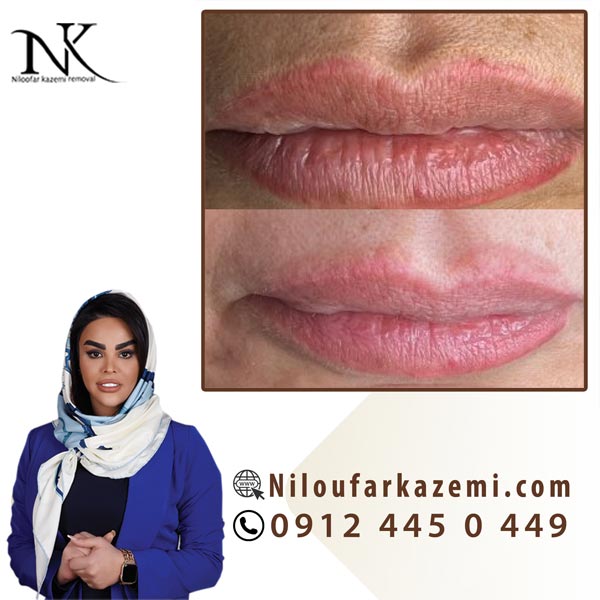 ریموو تاتو خط لب با تکنیک اختصاصی نیلوفر کاظمی