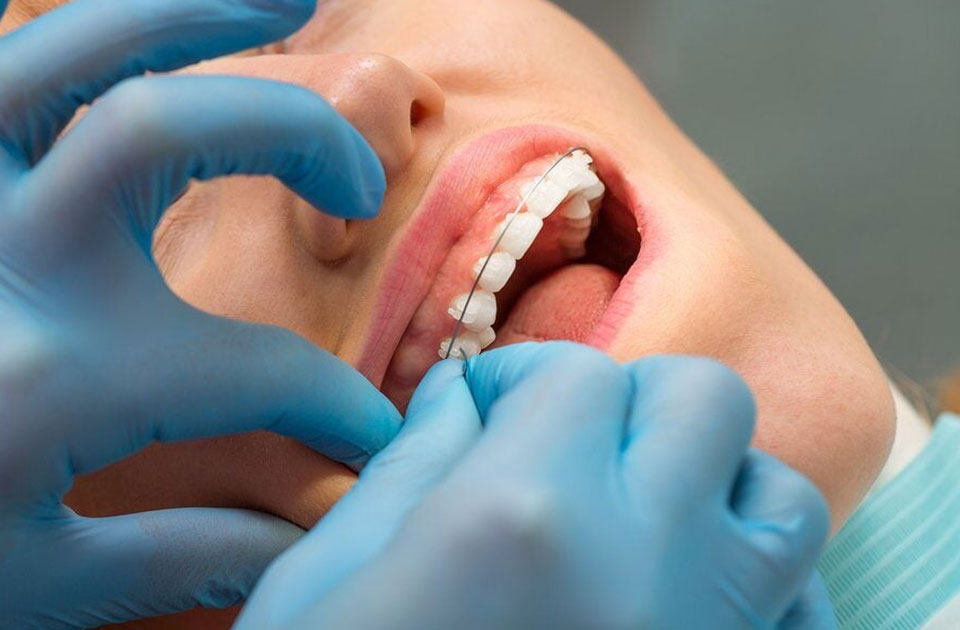 پاک کردن موم ارتودنسی 