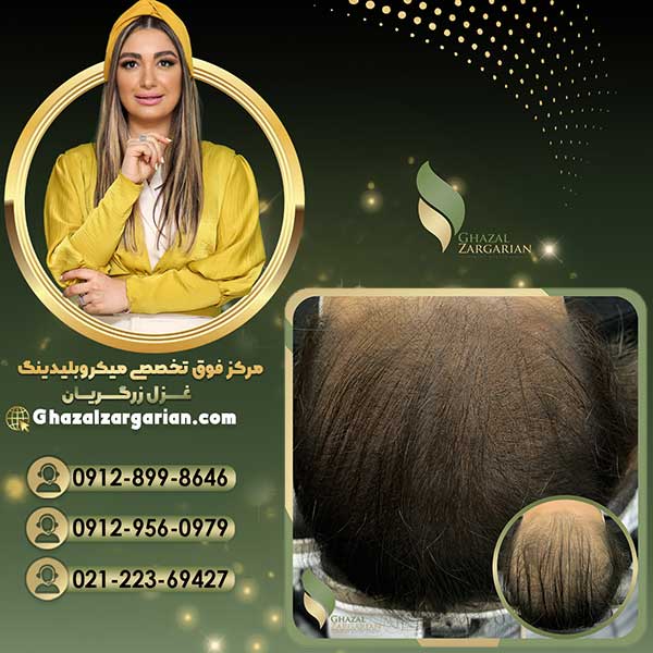 هاشور اسکالپ سر با قیمت عالی