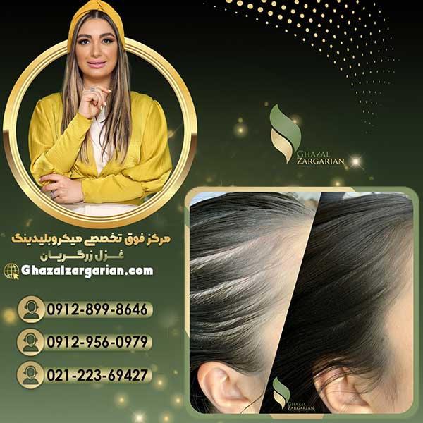 هاشور اسکالپ سر با روش های حرفه ای