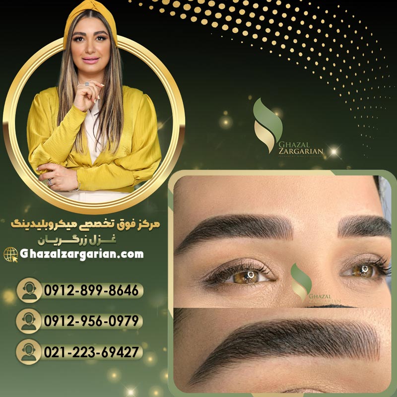 میکروبلیدینگ غزل زرگریان در تهران