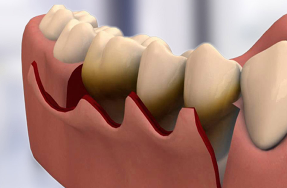 جراحی لثه چیست ؟