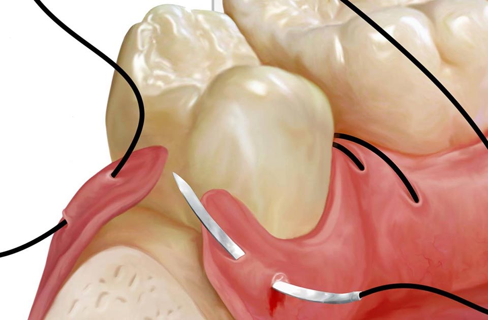 فرایند کشیدن بخیه دندان 