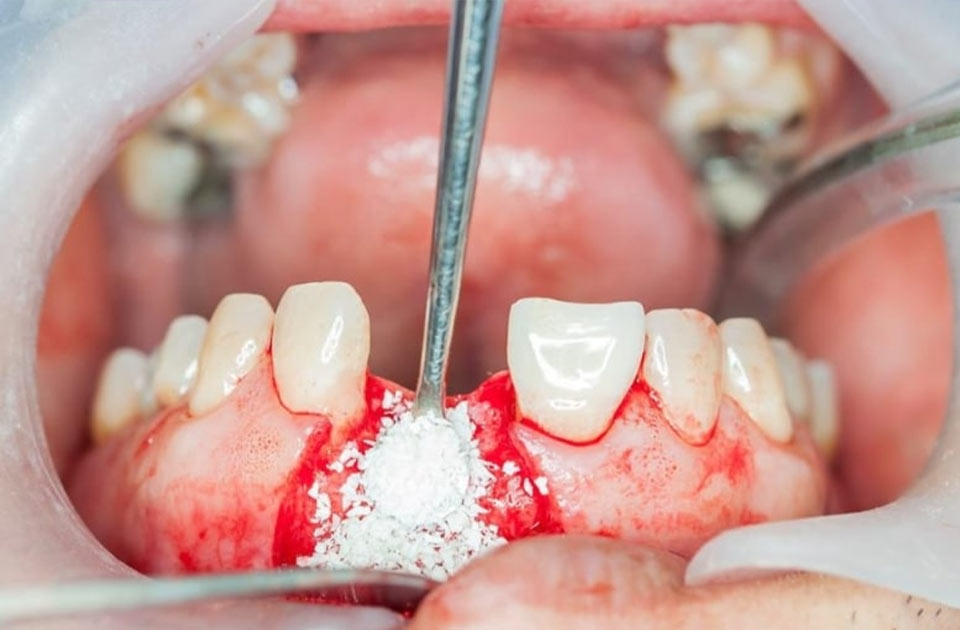 پیوند استخوان