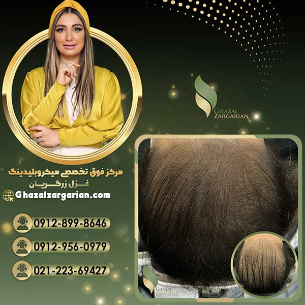 هاشور اسکالپ سر در تخصصی ترین مرکز