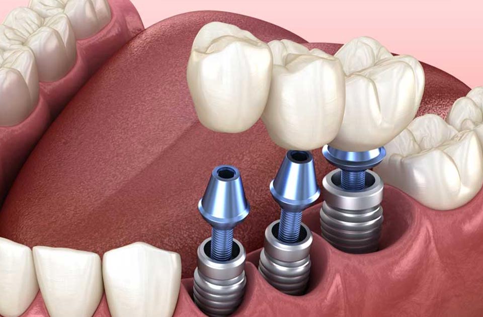 ایمپلنت چند دندان کنار هم 