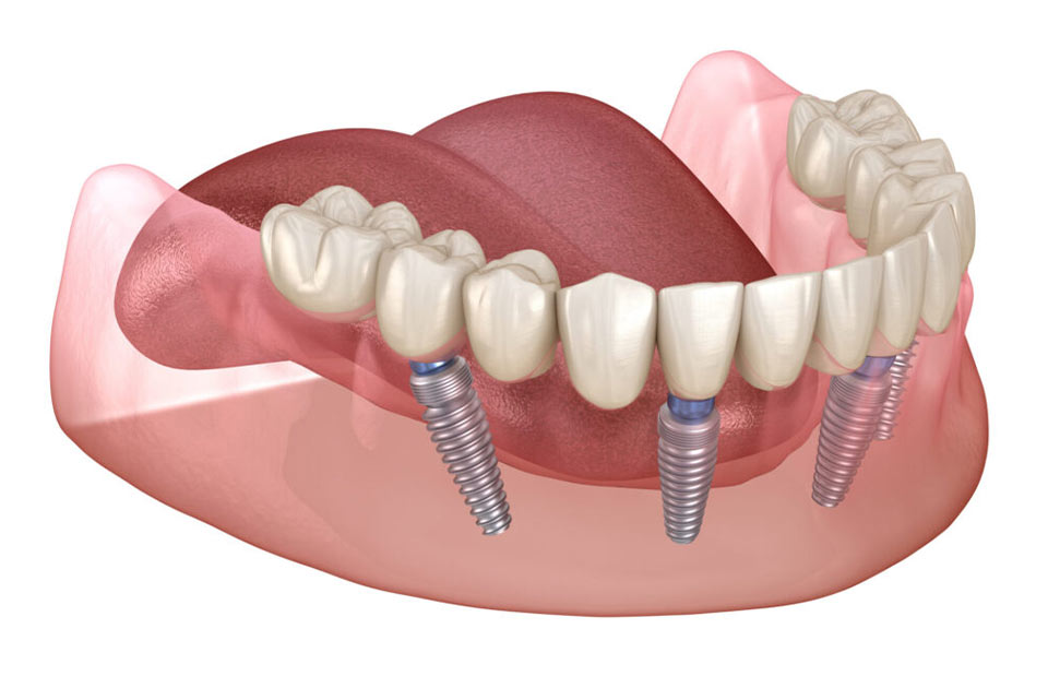 ایمپلنت دندان و تعریف آن
