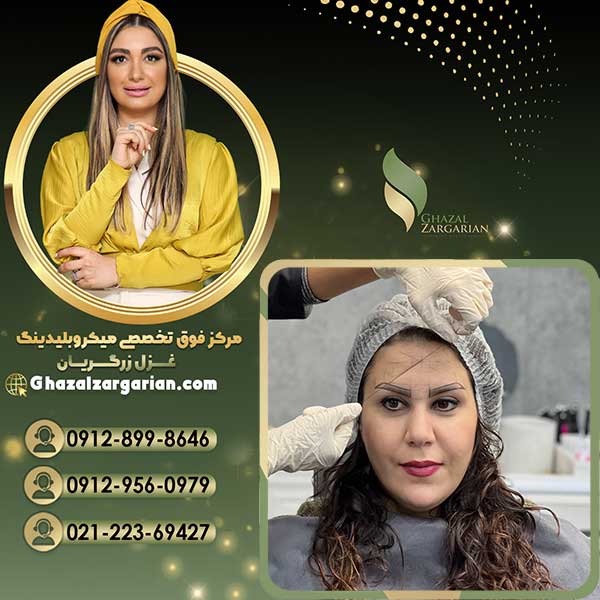 قیمت لیفت و لمنیت ابرو در مرکز پیشرفته