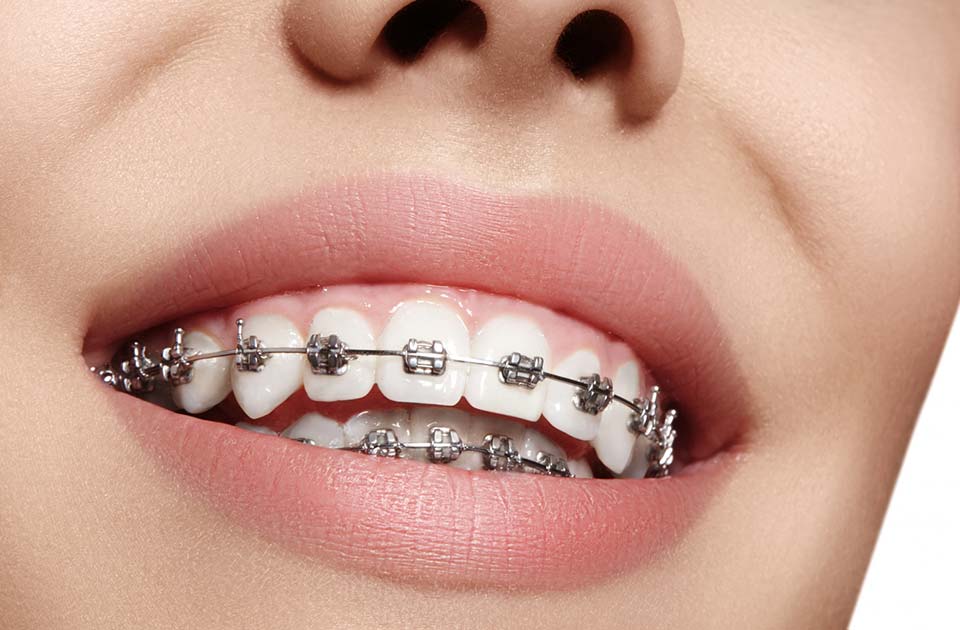 ارتودنسی سنتی 