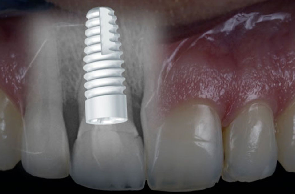 ایمپلنت سرامیکی 