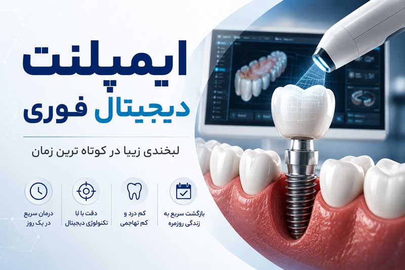 ایمپلنت دیجیتال فوری